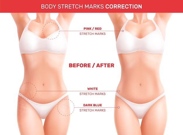 Before and after photos of liposuction and skin tightening procedure showcasing dramatic results