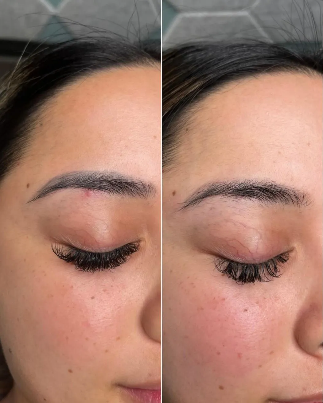 laser tattoo removal