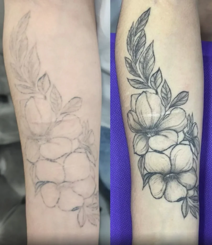 laser tattoo removal near me
