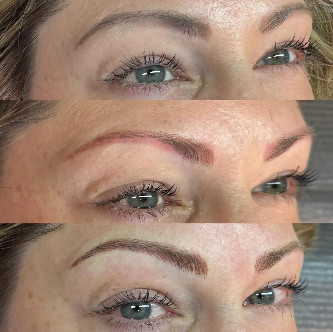 saline tattoo removal