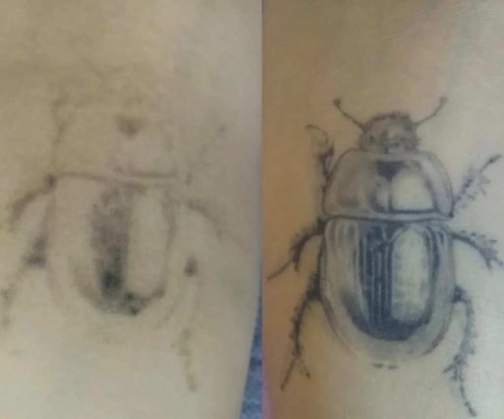 tattoo removal healing